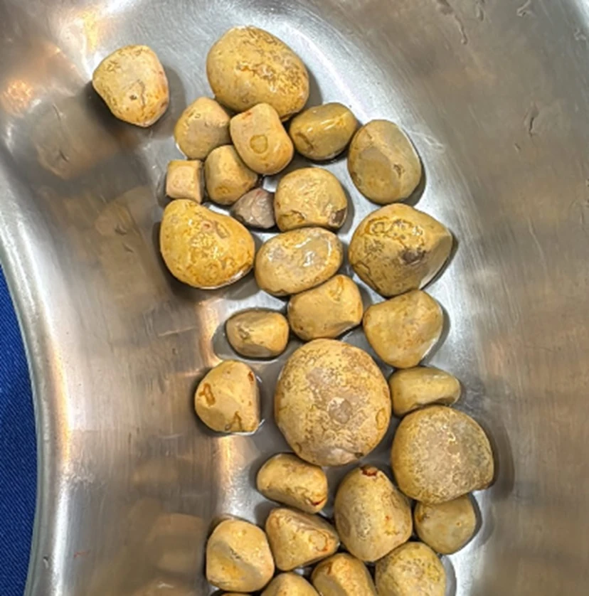 Médico retira 35 pedras da bexiga de homem que bebia coca-cola todos os dias