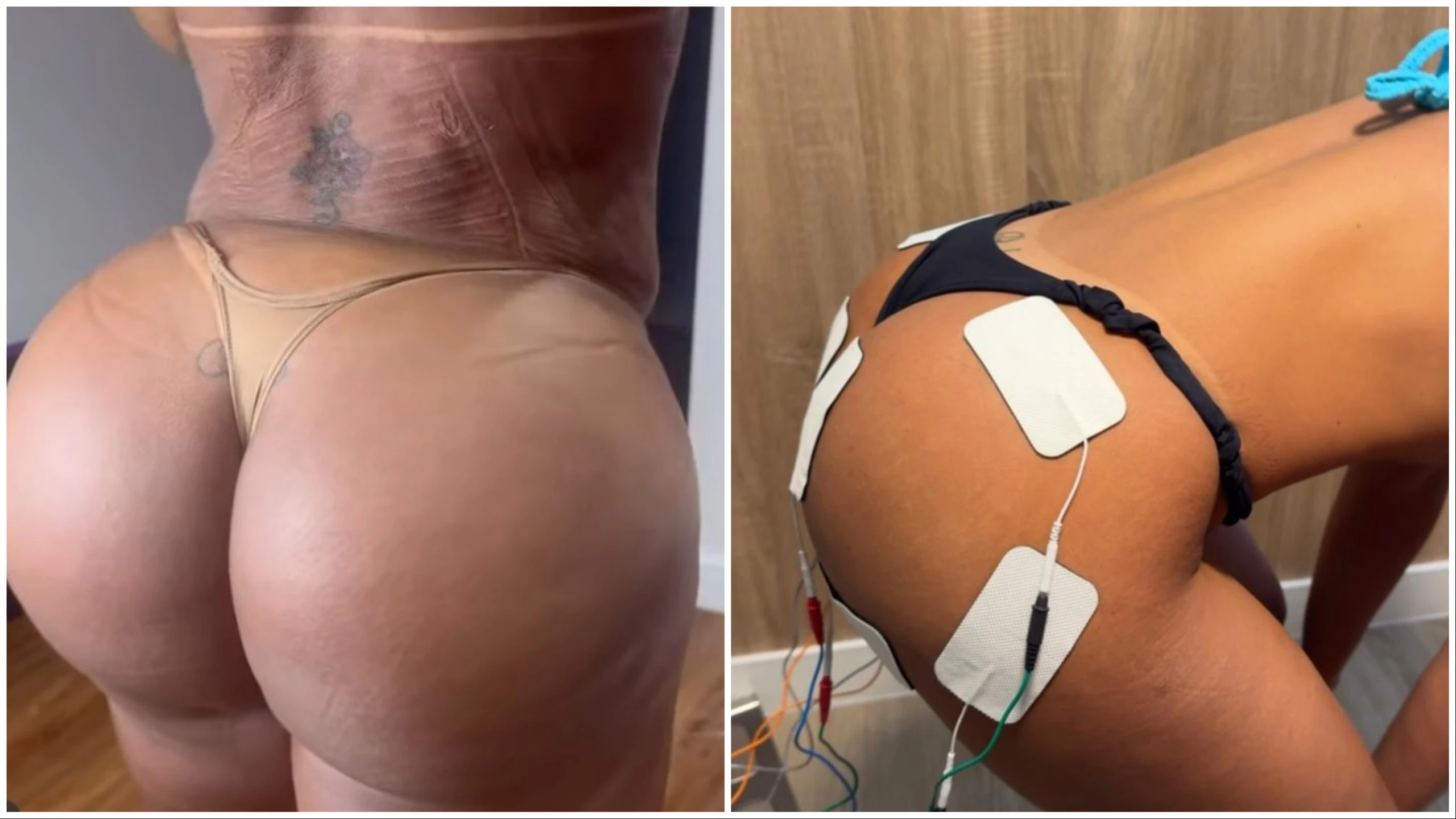 Quando o 'bumbum na nuca' vira um risco? Entenda como pode ser a hiperlordose