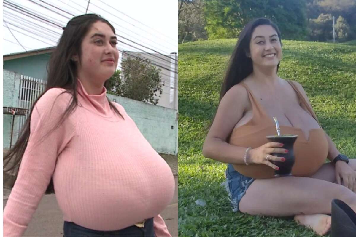 10 quilos de seios: entenda o que é gigantomastia, doença que afeta jovem no Paraná