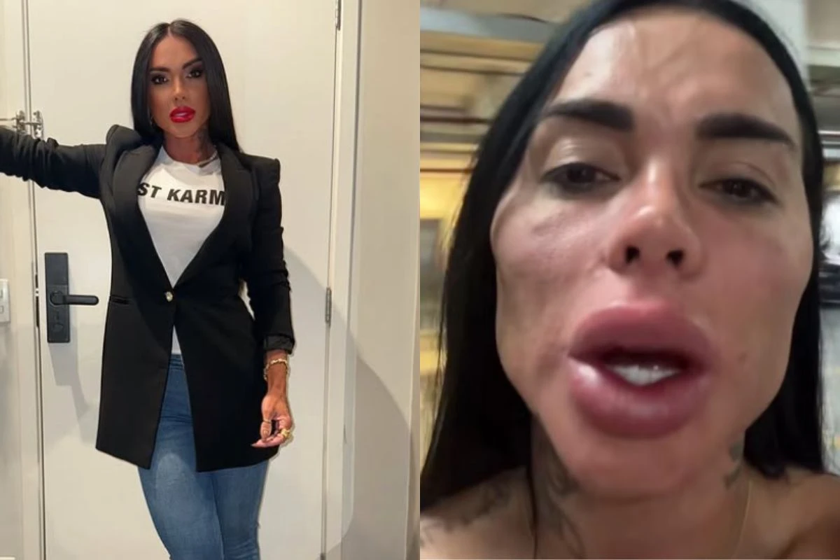 Eterno 'Cigano Igor' e +: veja antes e depois de famosos que fizeram harmonização facial