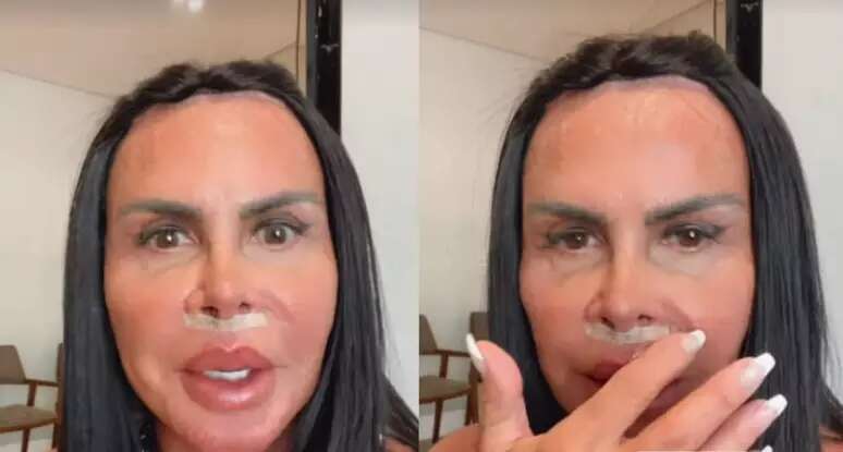 Gretchen remove preenchimento labial com substância de risco