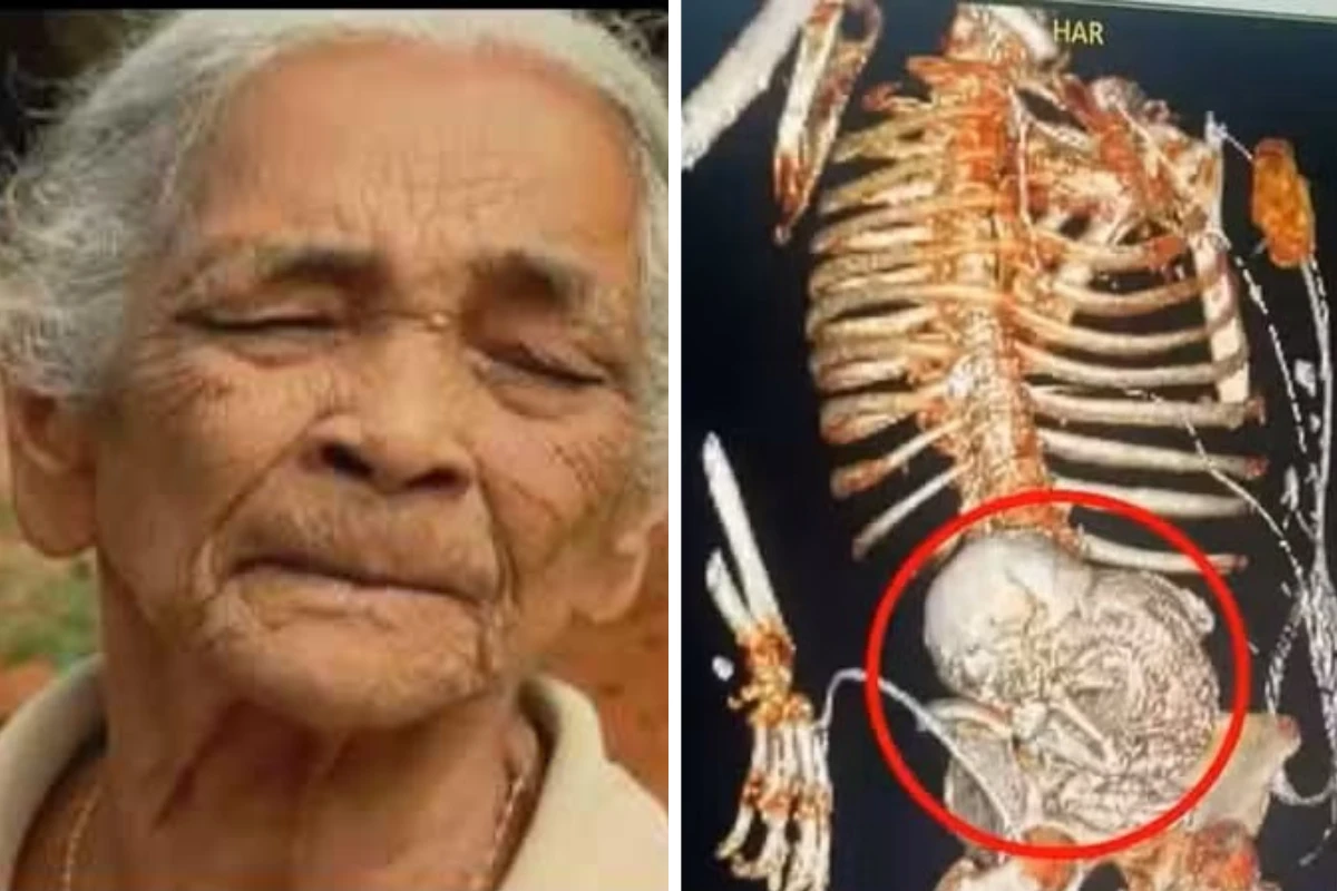 Após queixa de dor de barriga, idosa descobriu que carregava feto há mais de 40 anos