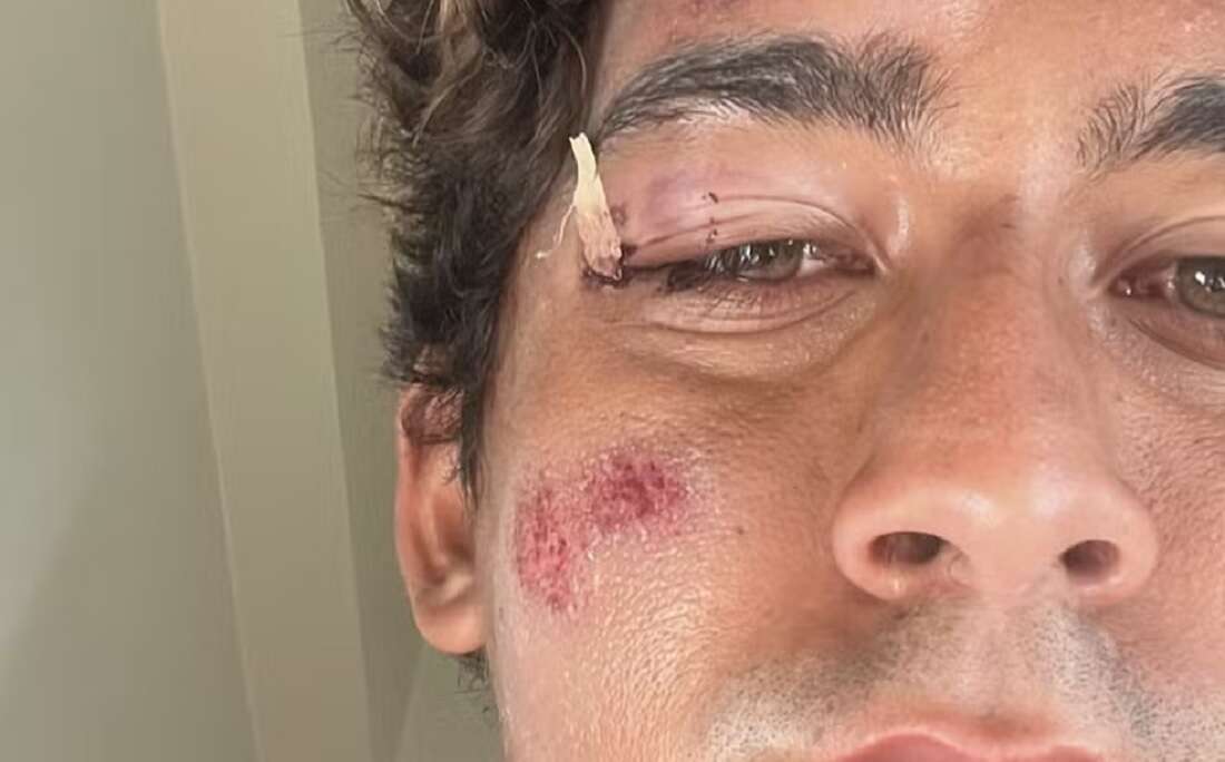 Surfista brasileiro sofre acidente durante treino no Havaí: 'Perdi os sentidos'