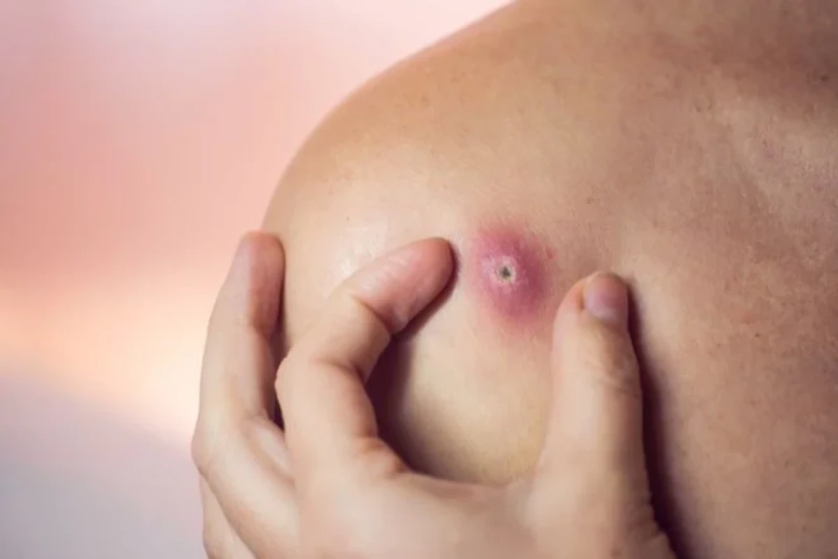 Furúnculo: espremer em casa pode fazer infecção parar no sangue ou crânio