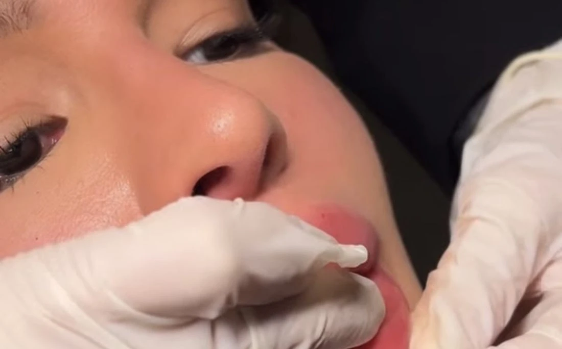 ANTES x DEPOIS: ex-BBB remove preenchimento labial: 'Agora vejo até mais meus dentes'