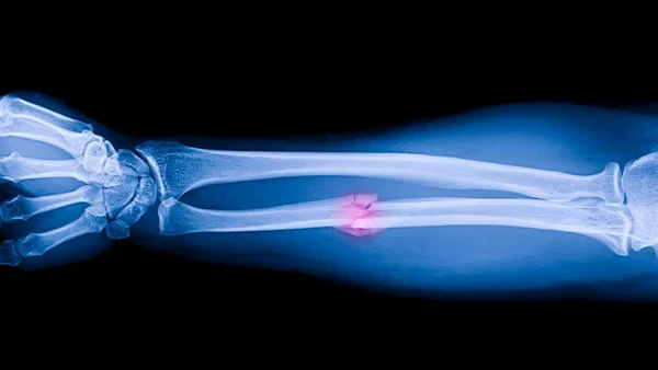 Cientistas criam cola que promete tratar ossos quebrados; veja como funciona