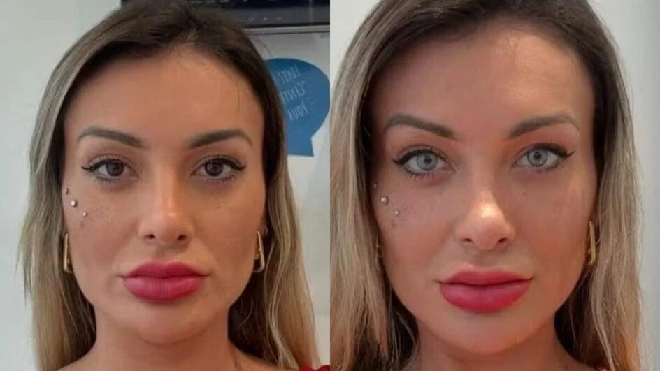 Andressa Urach muda cor dos olhos com cirurgia e se desespera: 'Muita dor, medo de ficar cega'