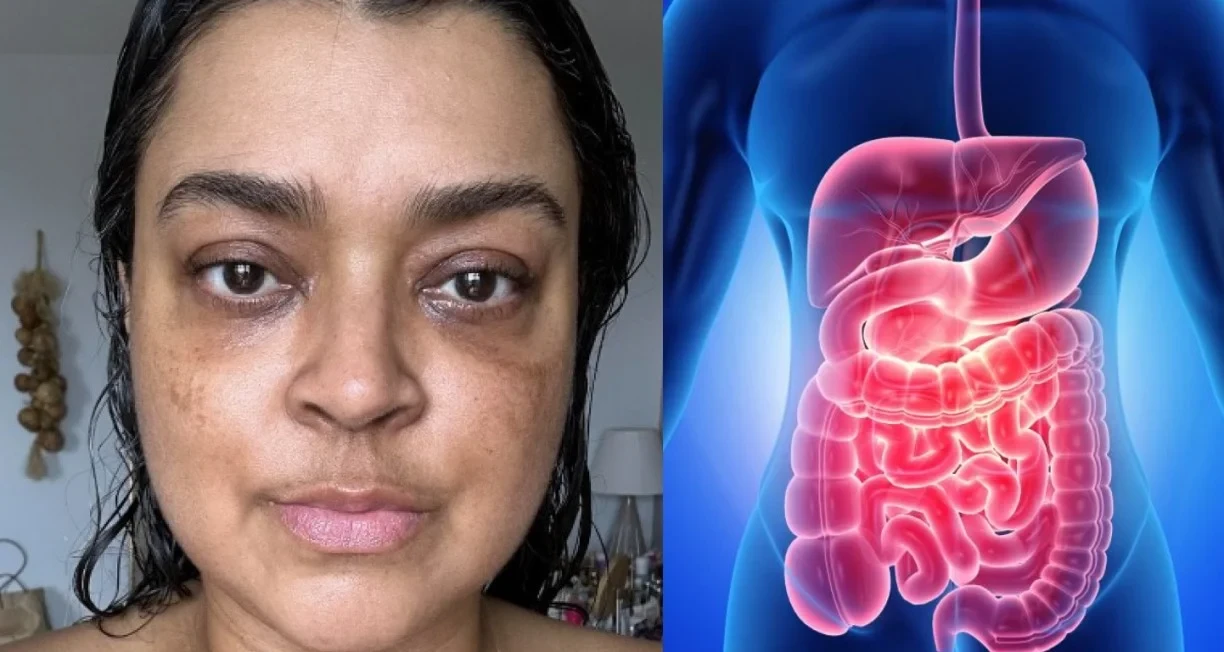 Conheça o exame de sangue simples que pode detectar câncer de intestino antes dos sintomas