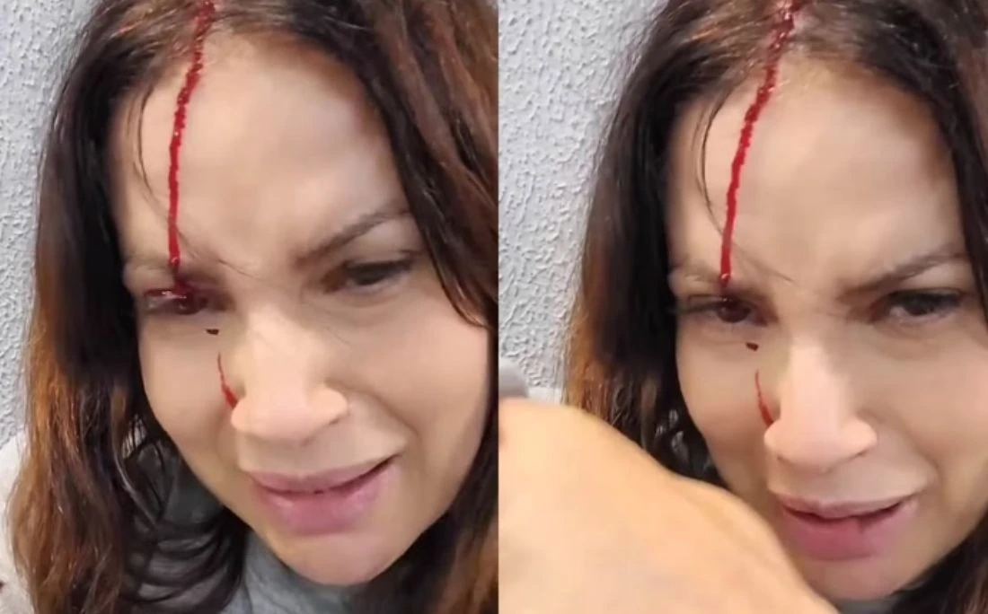Ex-atriz da Globo aparece sangrando em vídeo após acidente: 'Fiquem atentos'