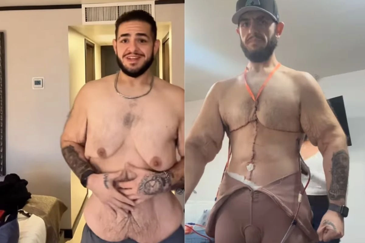 Influenciador que perdeu 150 kg faz cirurgia para retirar 7 kg de excesso de pele e impressiona; veja transformação