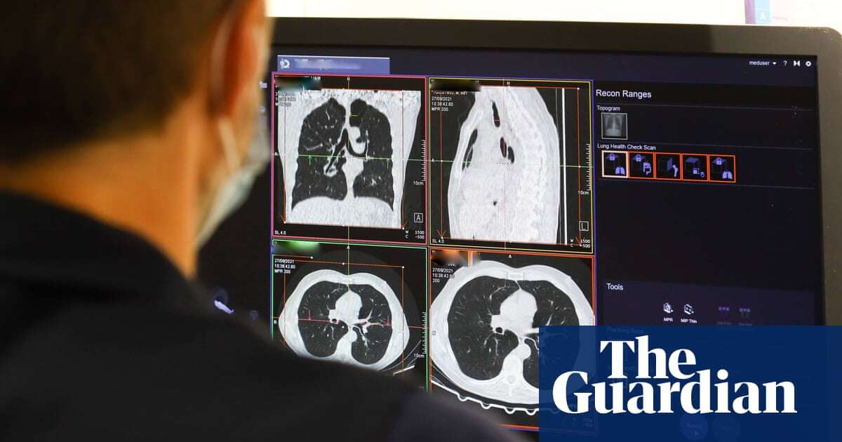 UK can expect ‘tsunami of missed cancers’ in wake of pandemic, experts say