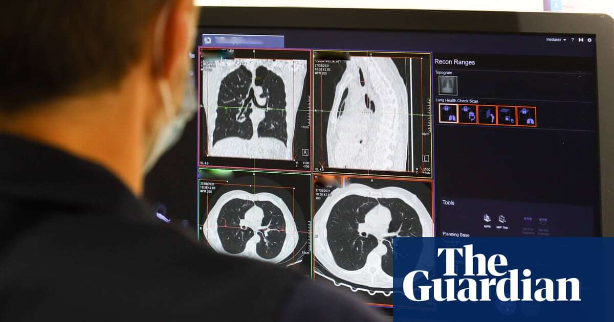 ‘Amazing’ trial shows drug combination stops lung cancer advancing for longer