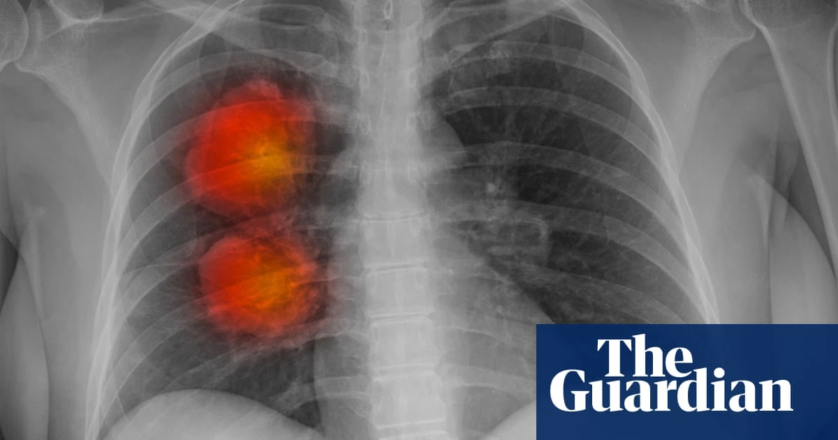 New artificial intelligence tool can accurately identify cancer