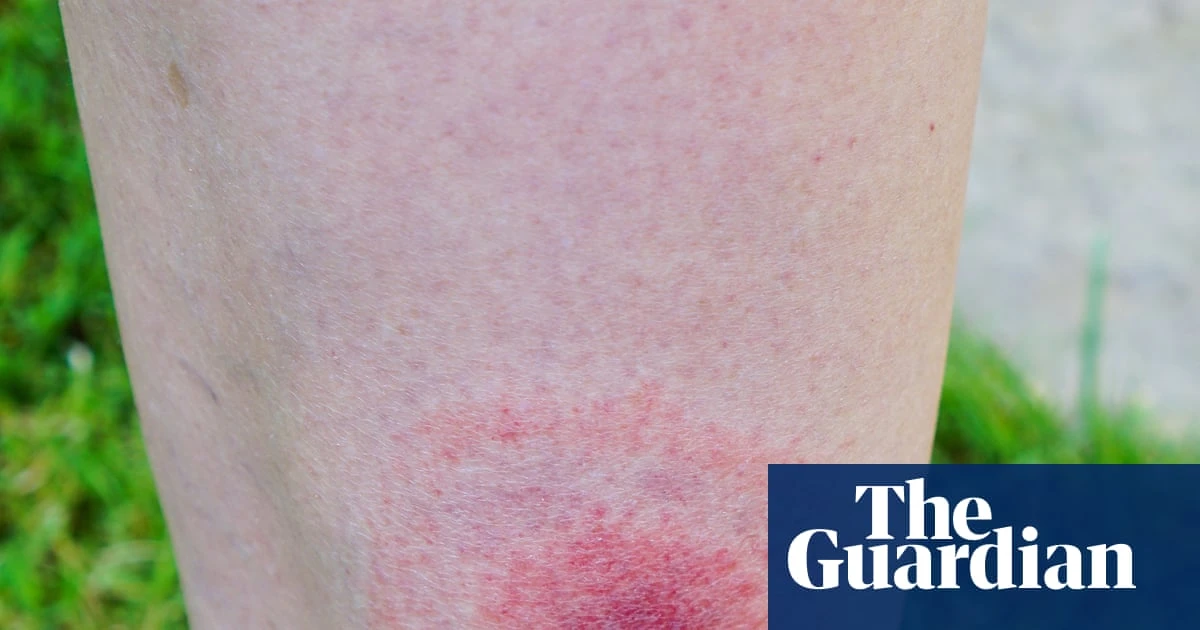 Lyme disease cases in England rise by more than 20% in a year