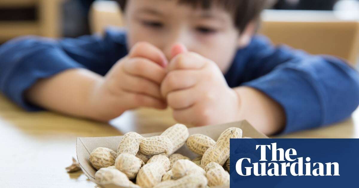 NHS trial uses daily doses of food allergens to tackle severe reactions