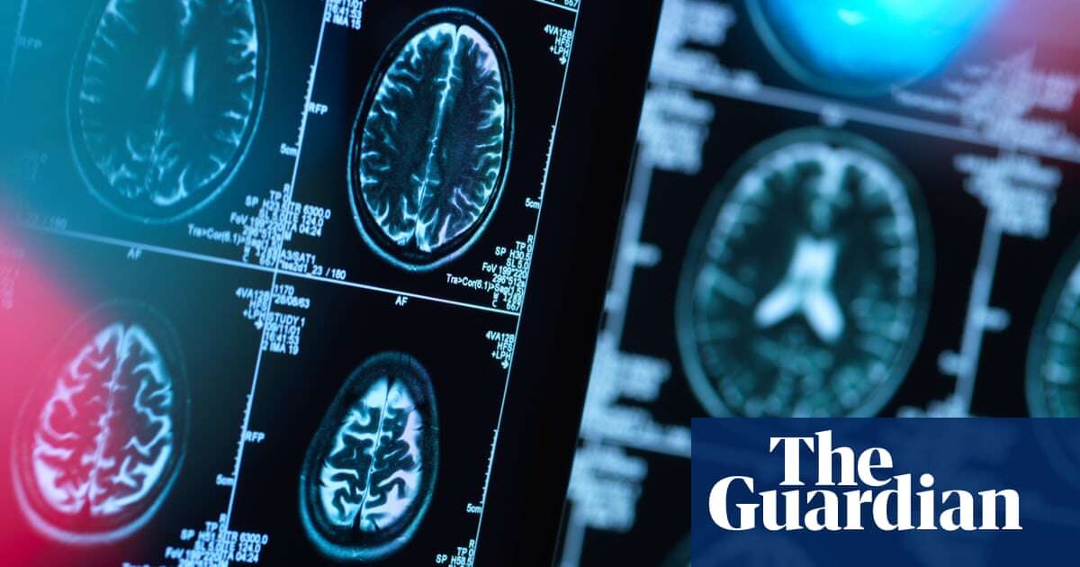 UK shortage of drug used to prevent brain damage in alcoholics