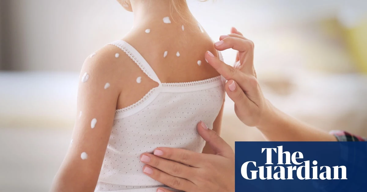 Chickenpox vaccine should be given to children on NHS, JCVI says