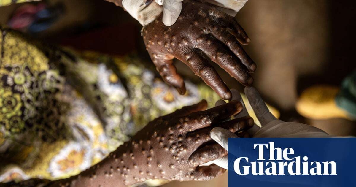 The race to understand mpox – podcast