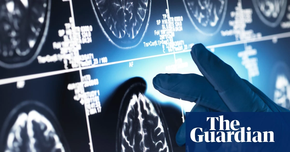 Effect of ‘gamechanger’ Alzheimer’s drugs ‘trivial’, review concludes