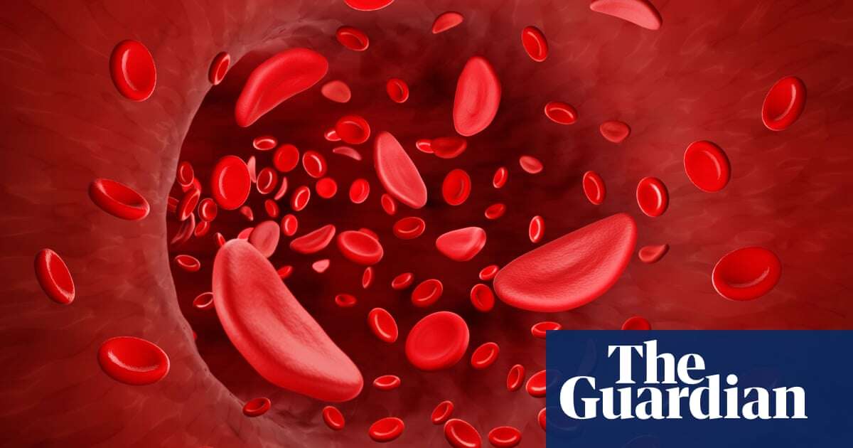 ‘Groundbreaking’ potential cure for sickle cell in England approved for NHS use