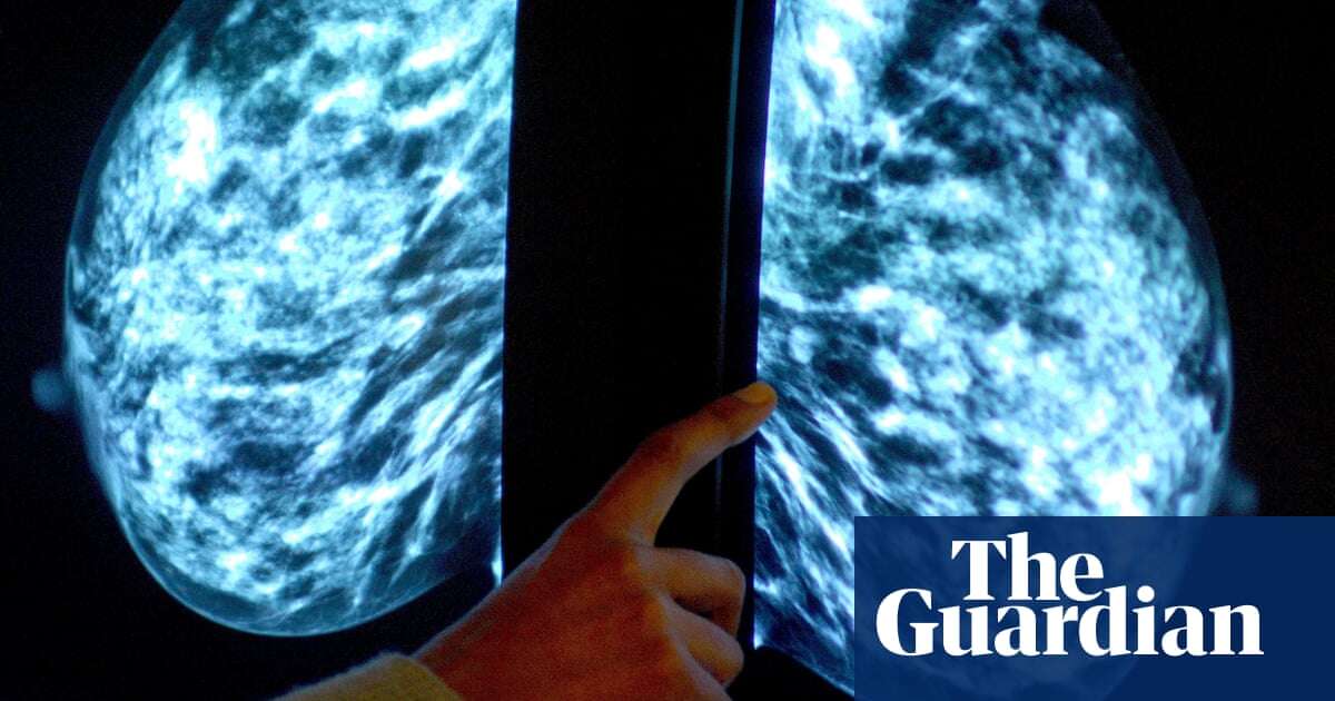 More breast cancer cases found when AI used in screenings, study finds