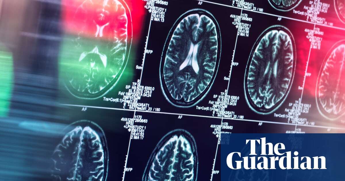 Brain scan study identifies potential targets to treat youths with severe depression