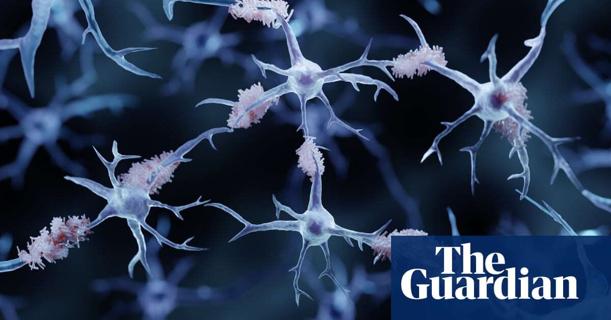 Science Weekly Are we finally nearing a treatment for Alzheimer’s?