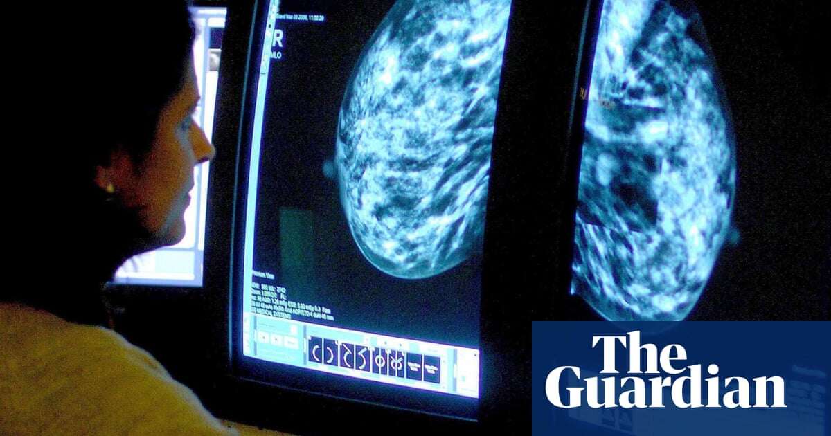 Medics design AI tool to predict side-effects in breast cancer patients