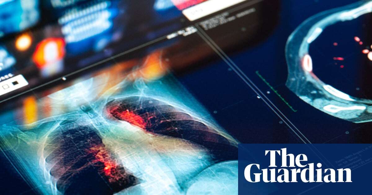 Trial results for new lung cancer drug are ‘off the charts’, say doctors