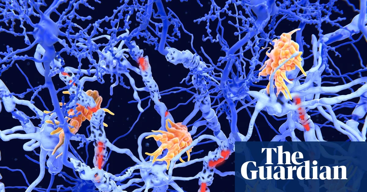 ‘Exciting’ clinical results offer hope for new class of MS therapies