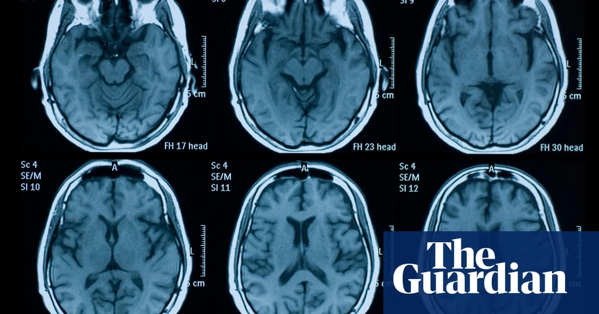 Psychology Myths about brain damage recovery