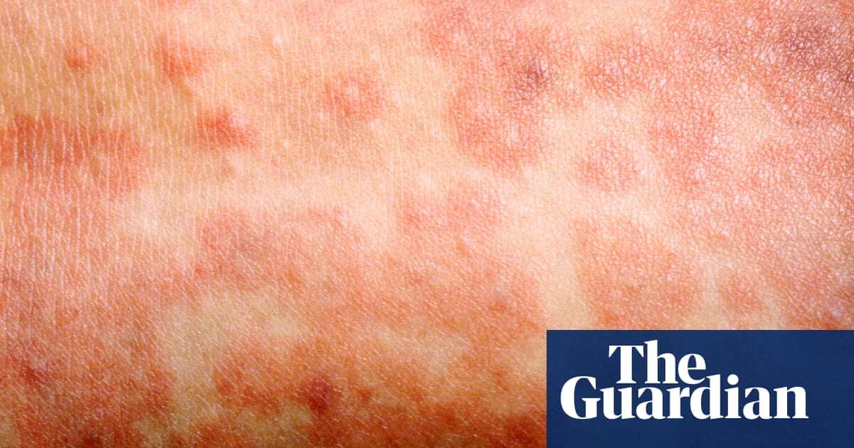 ‘Wake-up call’: Measles cases doubled in Europe last year, say WHO and Unicef