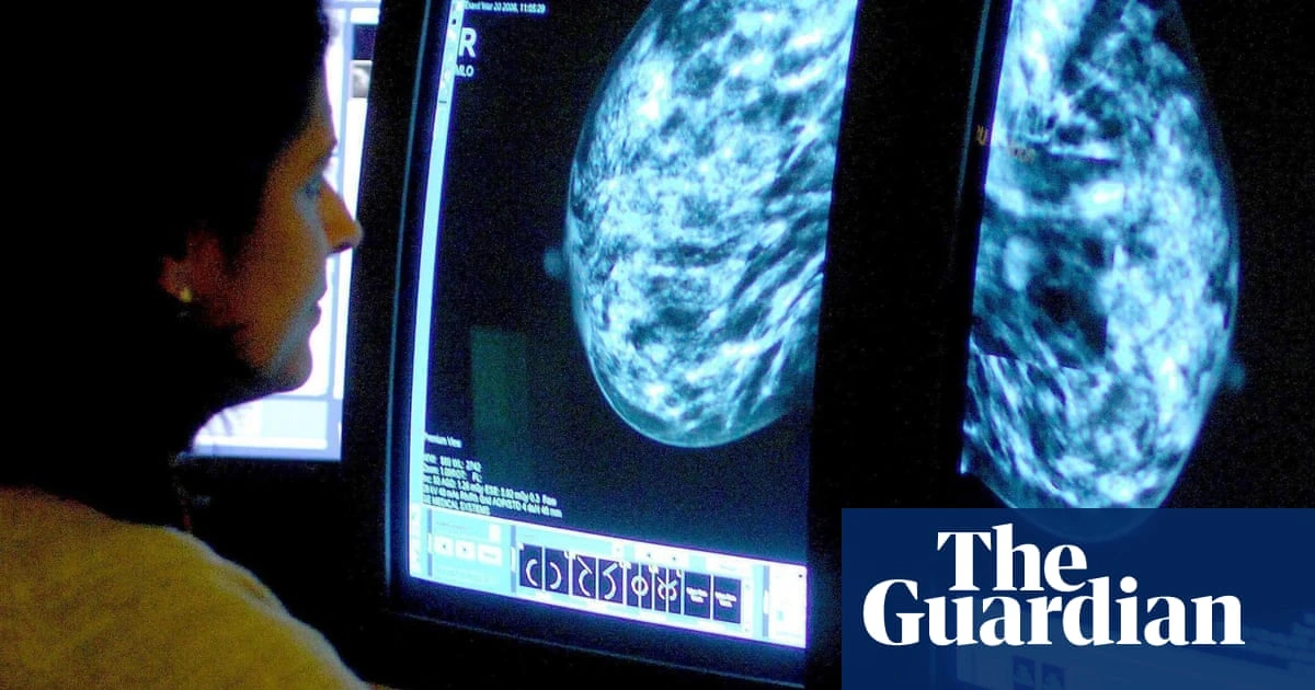 Extra cancer scans for women with dense breasts could save 700 lives a year – UK study