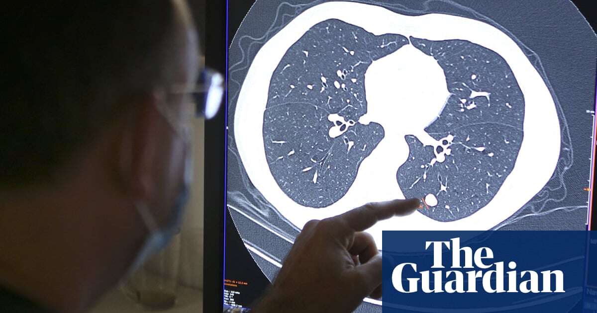 Study to look at why some people with aggressive cancer are ‘super-survivors’