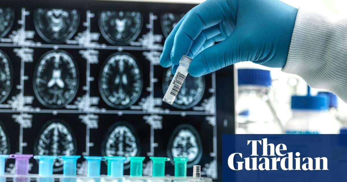 Alzheimer’s ‘breakthrough’ stalls: why a much-hyped drug is facing approval delays