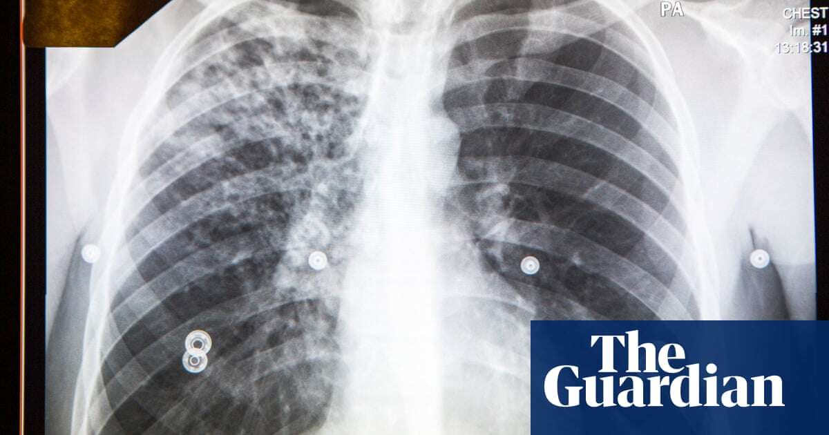 Kansas reckons with large tuberculosis outbreak as health officials hamstrung