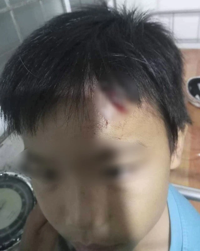 Điều tra vụ bé trai 10 tuổi nghi bị mẹ kế tiếp tục bạo hành