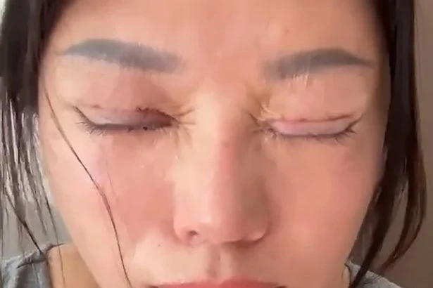 Woman forced to sleep with eyes open after plastic surgery goes 'horribly wrong'