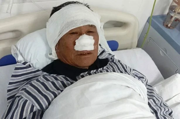 Man who had nose bitten off while saving woman from 'strangler' says 'I would do it again'