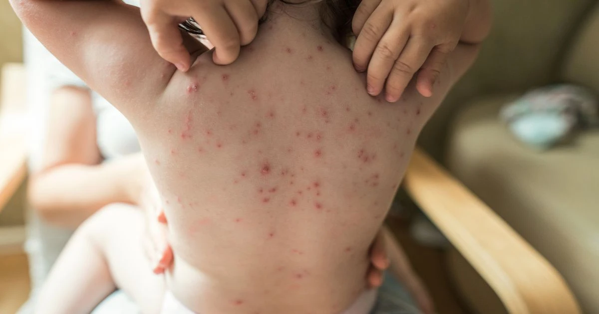 Early signs of chickenpox parents need to be on high alert for this winter - full list