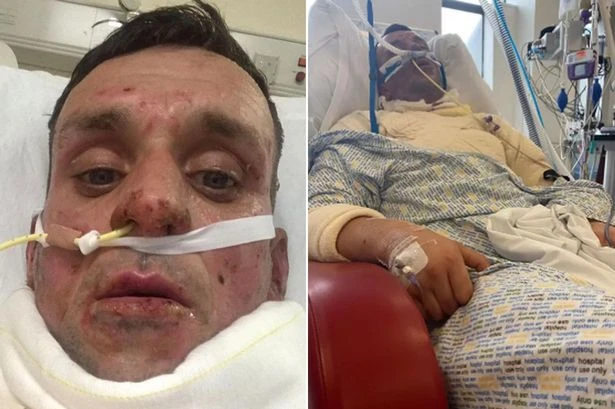Dad 'set on fire' at house party shares video of charred body from hospital bed