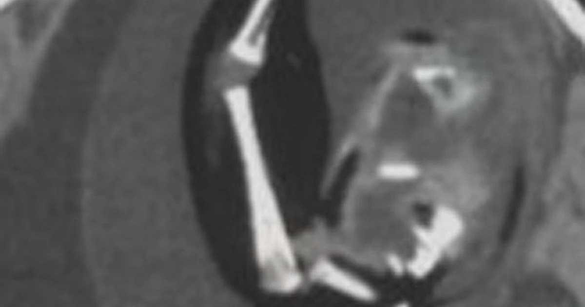 Doctors discover one-year-old girl has foetus growing in skull that was her twin sister
