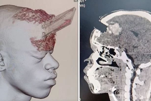 Builder miraculously survives as wooden stake is driven into his skull in freak work accident