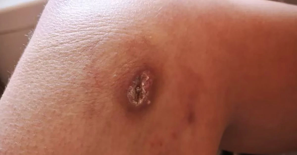 Woman left with black hole burned into her leg after falling asleep on phone chargerHorrific injuries
