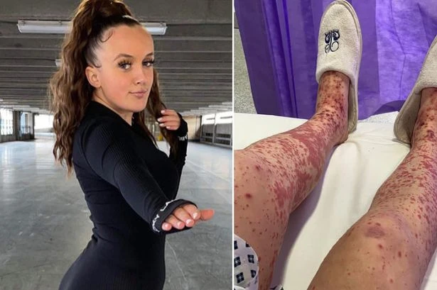 Teenager's 'veins burst leaving her in wheelchair' after rare reaction to Covid vaccine