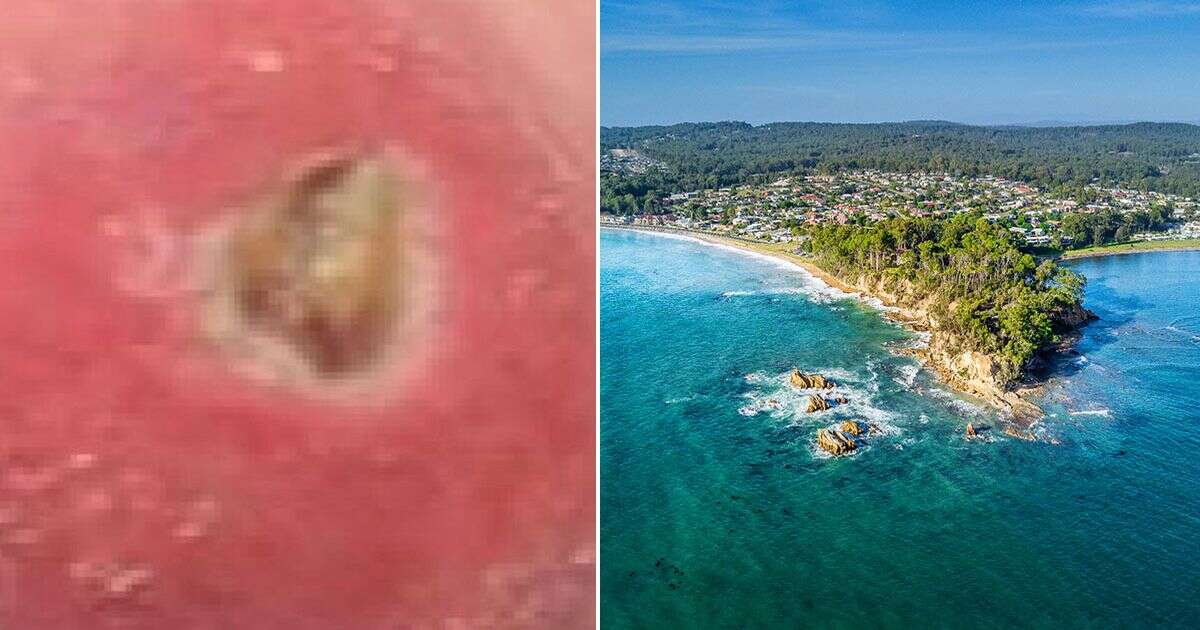 Horror warning as sickening flesh-eating ulcer disease starts spreading in UK holiday hotspot