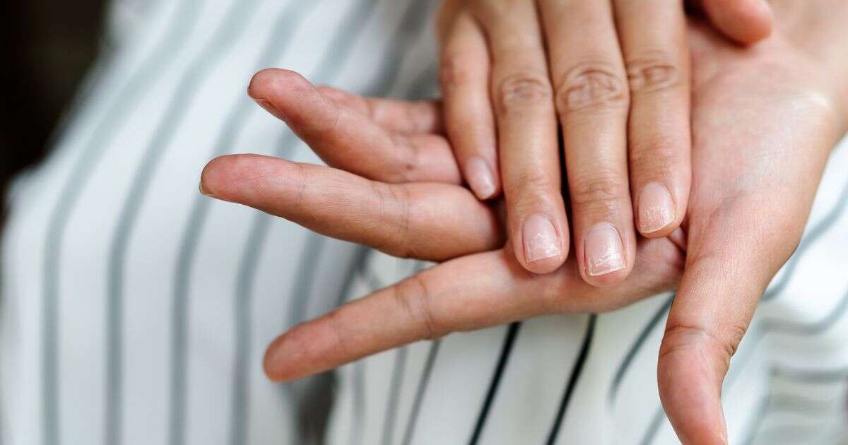 Red flag changes to your fingernails that might mean high cholesterol