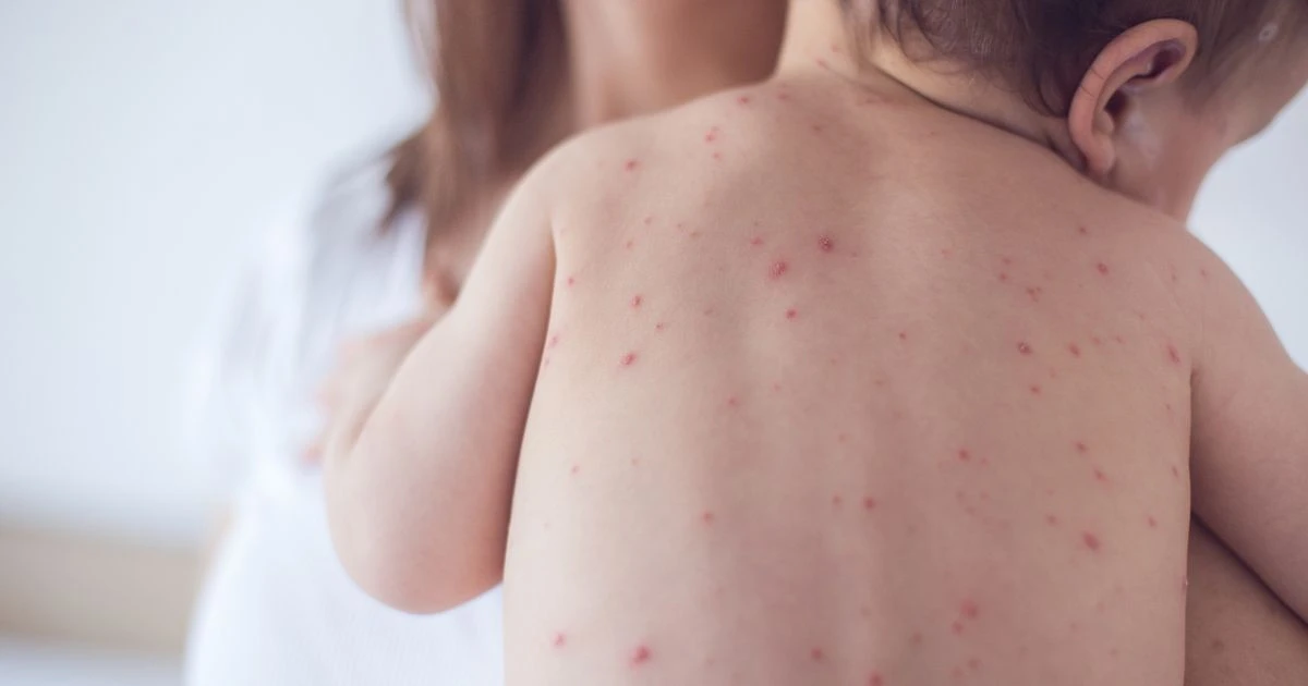 Chickenpox vaccine: Kids between 12 and 18 months should get two doses of jab