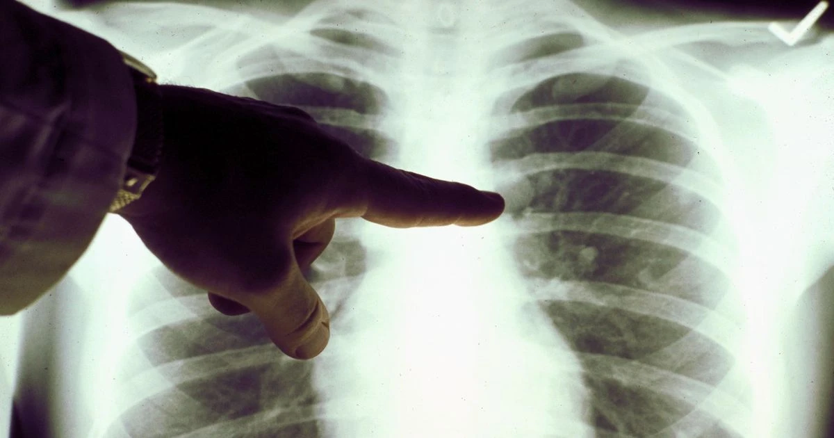 Coronavirus is filling some patients' lungs with liquid 'jelly', doctors warn