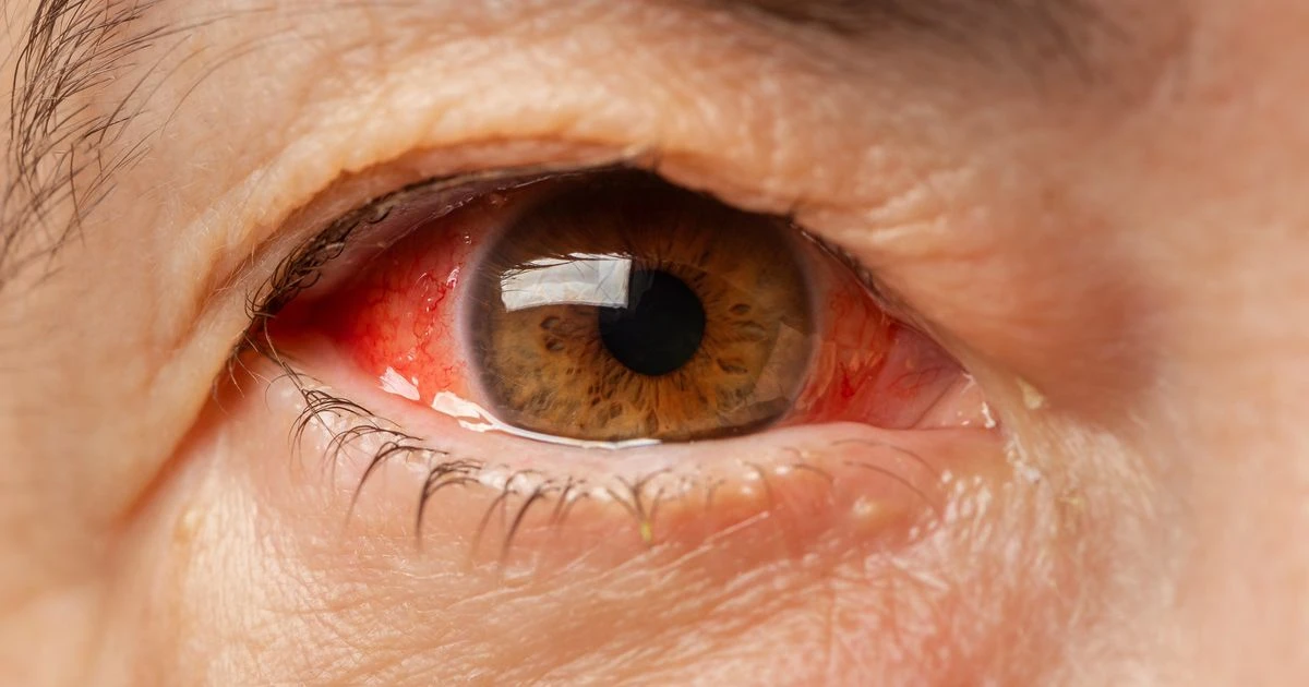 Eleven warning signs of cancer you can see in your eyes - from dark spots to pale lumps